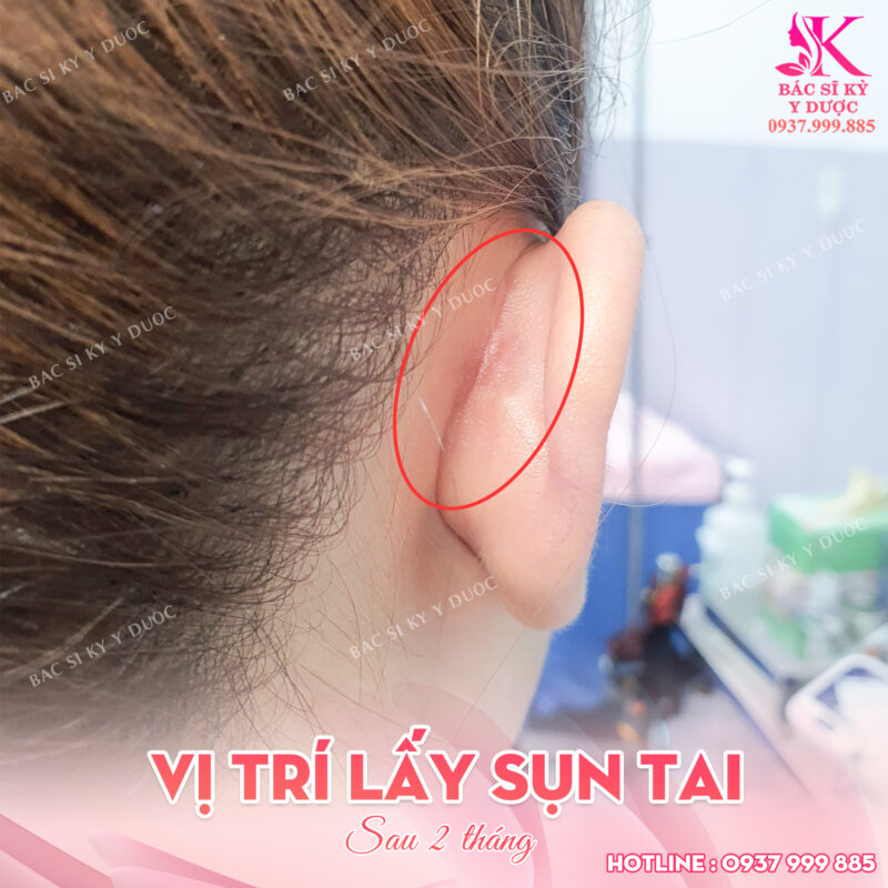 Vị trí lấy sụn tai
