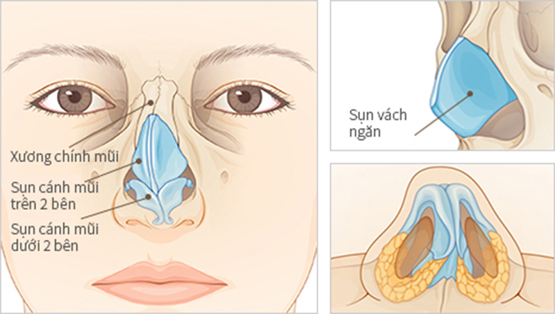 sụn vách ngăn dùng để nâng mũi