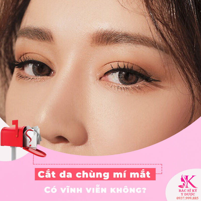 Cắt da chùng mí mắt trên có được loại bỏ vĩnh viễn