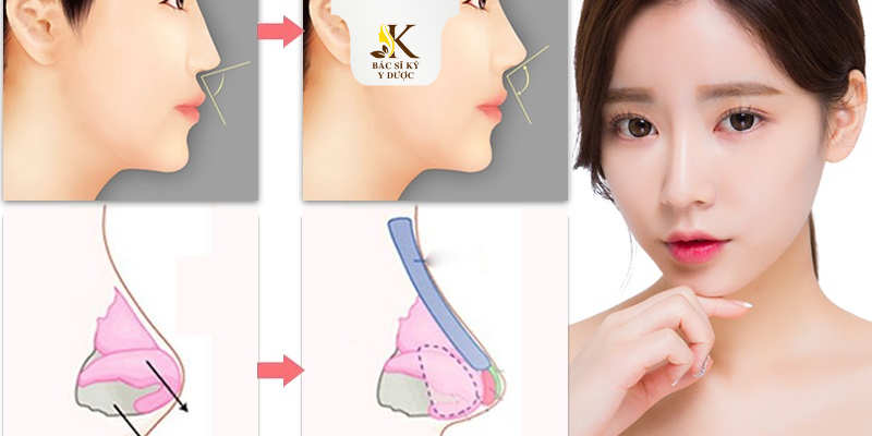 nâng mũi cấu trúc được bao lâu