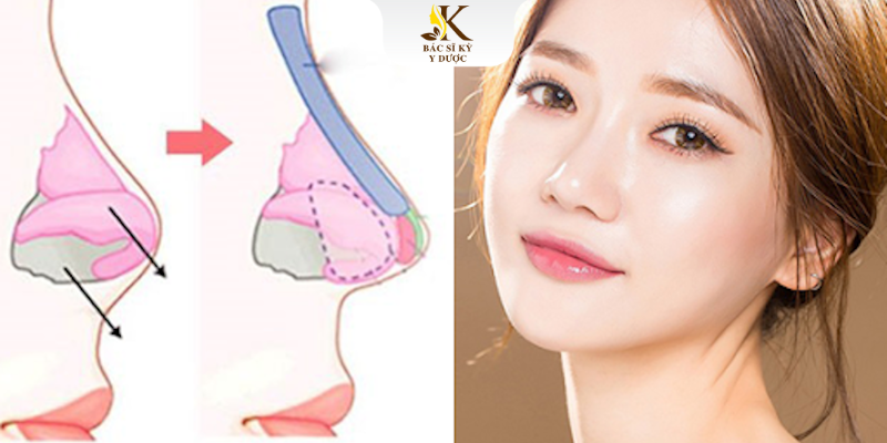 Nâng mũi sụn nhân tạo 