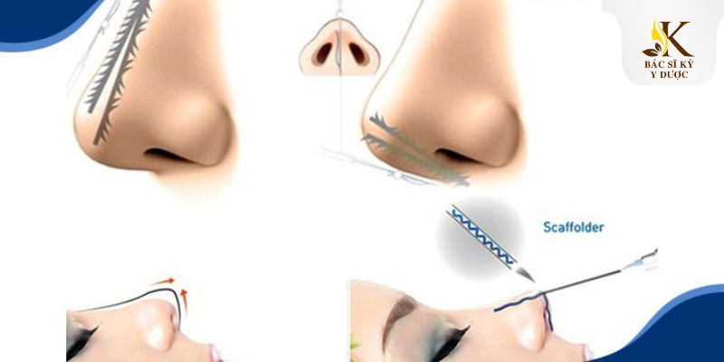 Những điều cần biết về nâng mũi chỉ