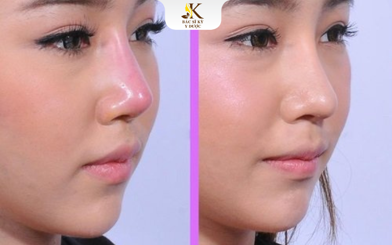 nâng mũi bị đỏ đầu mũi