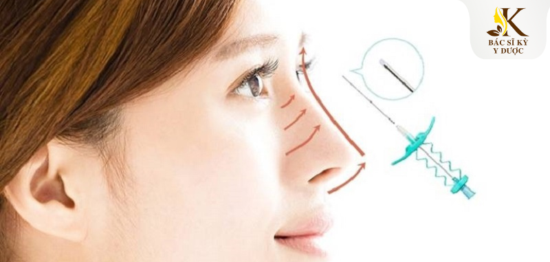 Nâng mũi bằng chỉ