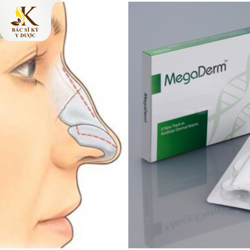 BỌC SỤN MEGADERM BẢO VỆ ĐẦU MŨI VÀ CÁNH MŨI HIỆU QUẢ