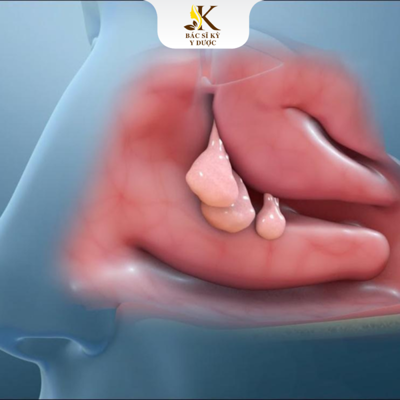 Phương pháp điều trị polyp mũi