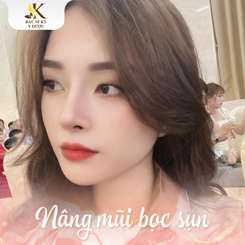 nâng mũi bọc sụn S Line
