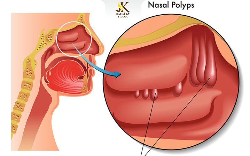 Polyp mũi