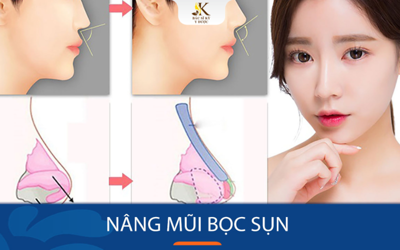 nâng mũi bọc sụn s line là gì
