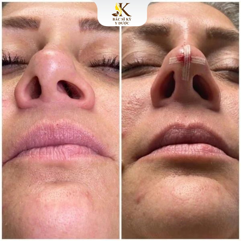 Biến chứng nâng mũi