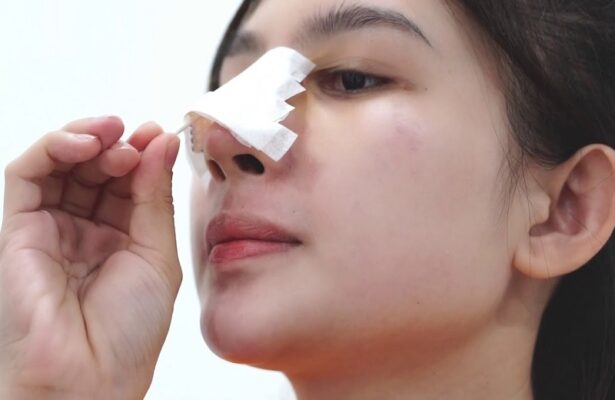 Tụ dịch sau nâng mũi