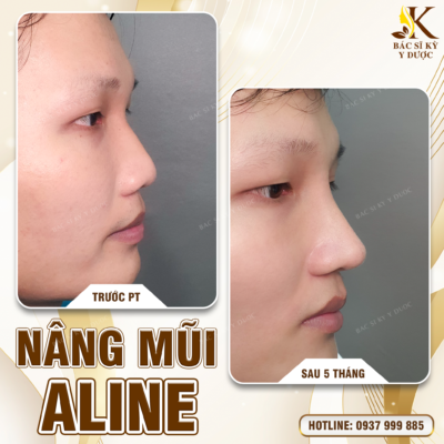 Nam giới có nên nâng mũi không? Nâng mũi ở đâu là đẹp nhất?