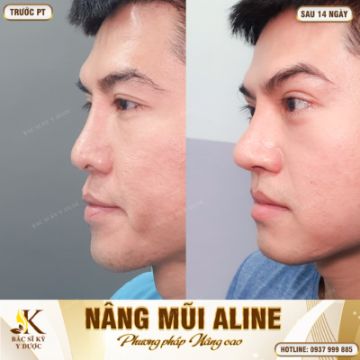 Nam giới có nên nâng mũi không? Nâng mũi ở đâu là đẹp nhất?