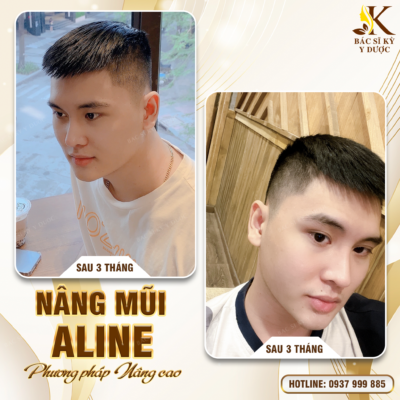 Nam giới có nên nâng mũi không? Nâng mũi ở đâu là đẹp nhất?