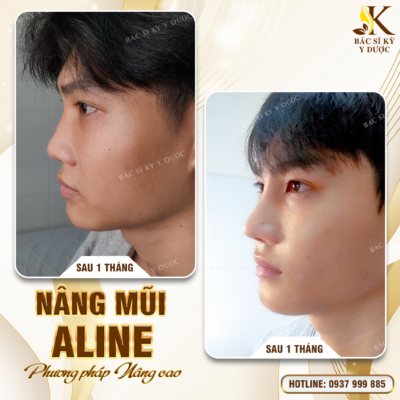 Nâng mũi cho nam bao nhiêu tiền