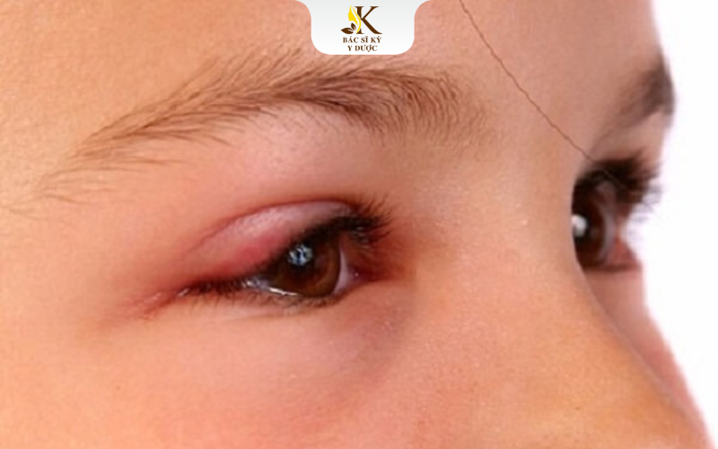 Cắt mí sau 1 tháng vẫn sưng