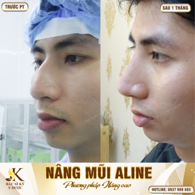 Nâng mũi cho nam bao nhiêu tiền