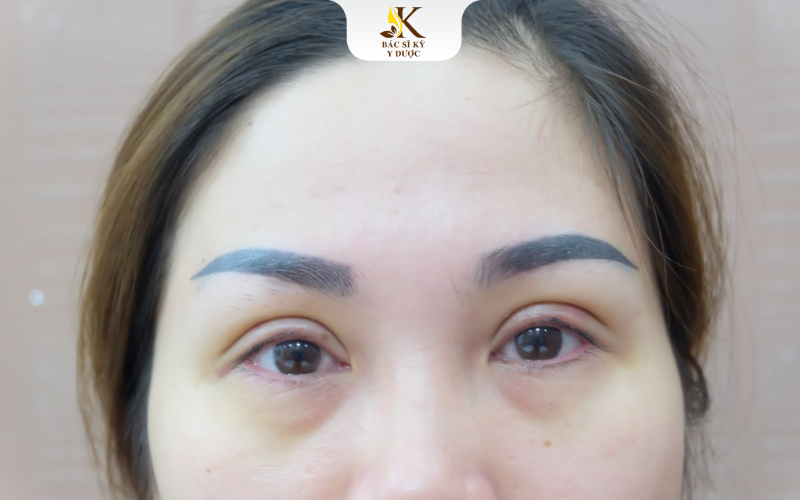 Ưu điểm cắt mí Plasma