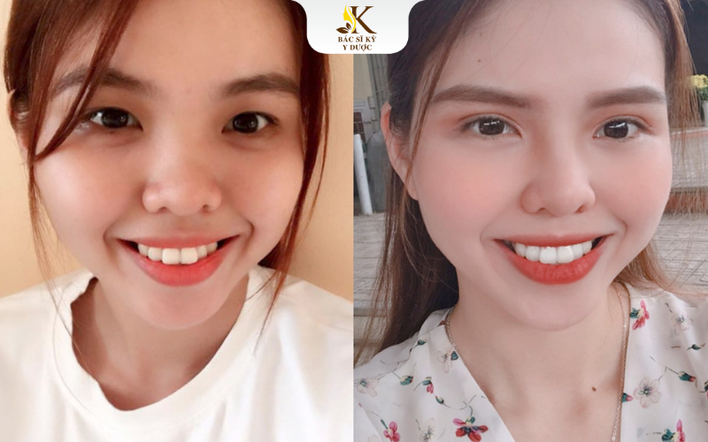 Cách khắc phục cắt mí bị sưng