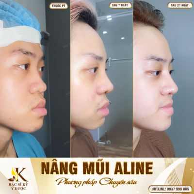 Nam giới có nên nâng mũi không? Nâng mũi ở đâu là đẹp nhất?