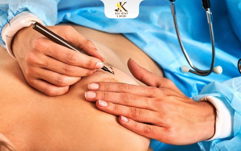 Phương pháp nâng ngực cho người chuyển giới