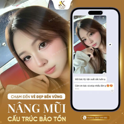 feedback nâng mũi cấu trúc bảo tồn