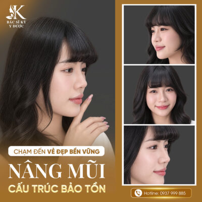 Khách hàng sau 1,5 tháng nâng mũi cấu trúc bảo tồn